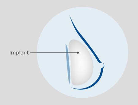 1st-stage-reconstruction-tiny 1st-stage-reconstruction-tiny